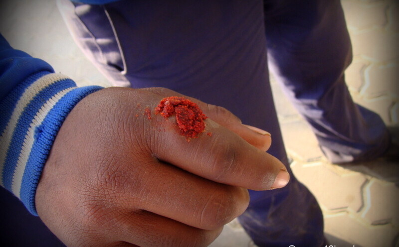 Unbelievable Traditional Remedy for a Boil on Finger